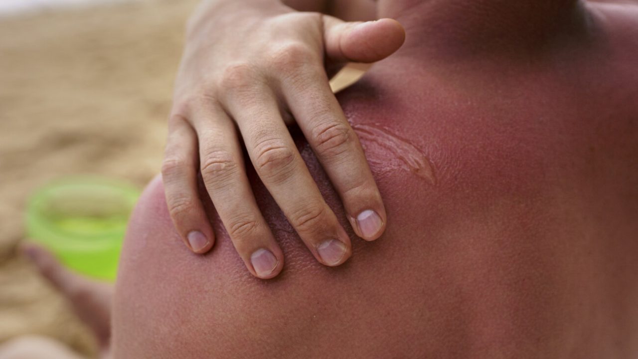 view-man-applying-lotion-sunburn-skin-beach